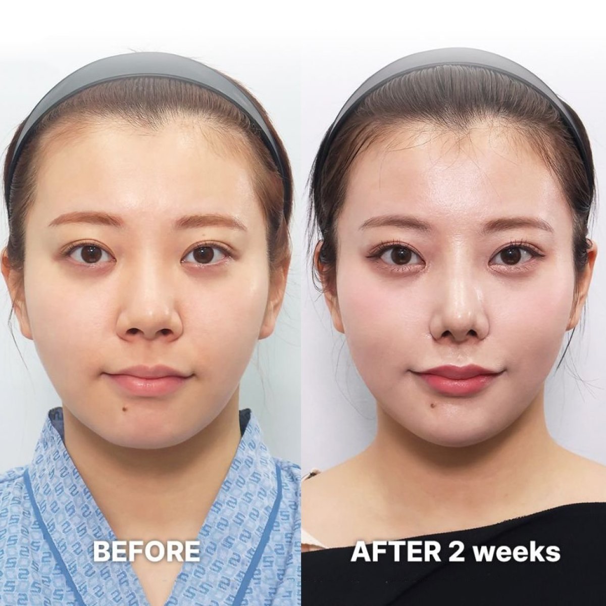 Tip rhinoplasty before and after results at Returning Plastic Surgery, refined nose shape