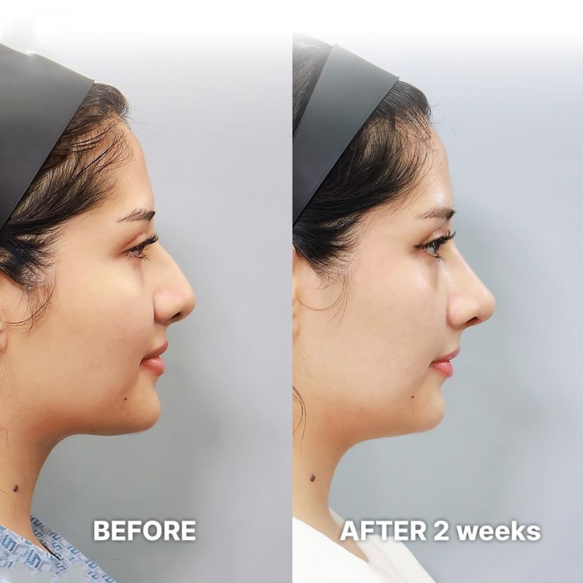 نتائج قبل وبعد تجميل طرف الأنف في Returning Plastic Surgery، تغيير واضح لشكل الأنف