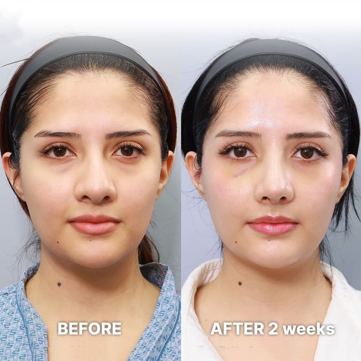 نتائج قبل وبعد تجميل طرف الأنف في Returning Plastic Surgery بعد أسبوعين