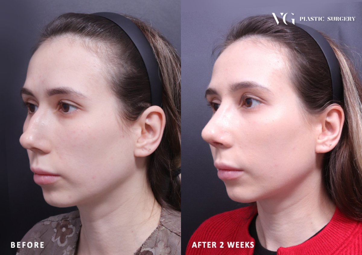 Resultados de rinoplastia antes y después en VG Plastic Surgery, forma de nariz mejorada tras 2 semanas