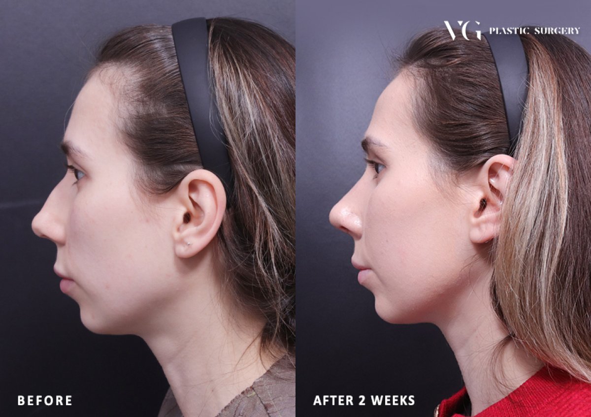 Resultados de rinoplastia antes y después en VG Plastic Surgery, forma de nariz mejorada tras 2 semanas