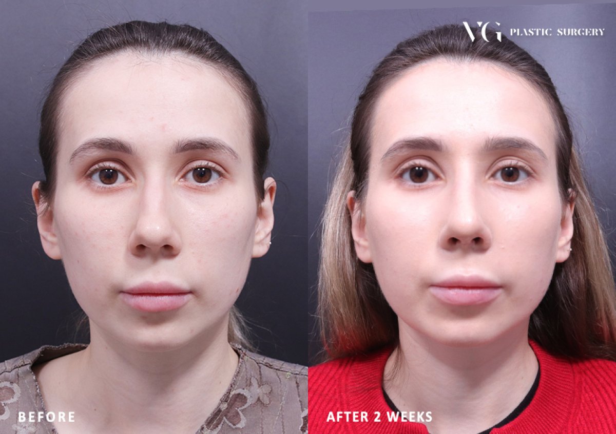 Resultados de rinoplastia antes y después en VG Plastic Surgery, remodelación nasal tras 2 semanas