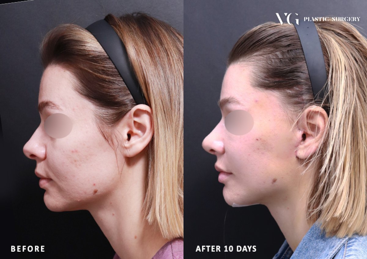 Resultados de minilifting facial antes y después en VG Plastic Surgery, mejora del contorno