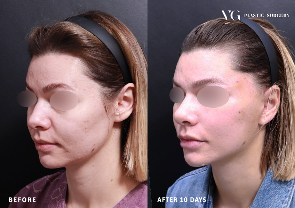 Mini facelift before and after results at VG Plastic Surgery – visible facial rejuvenation