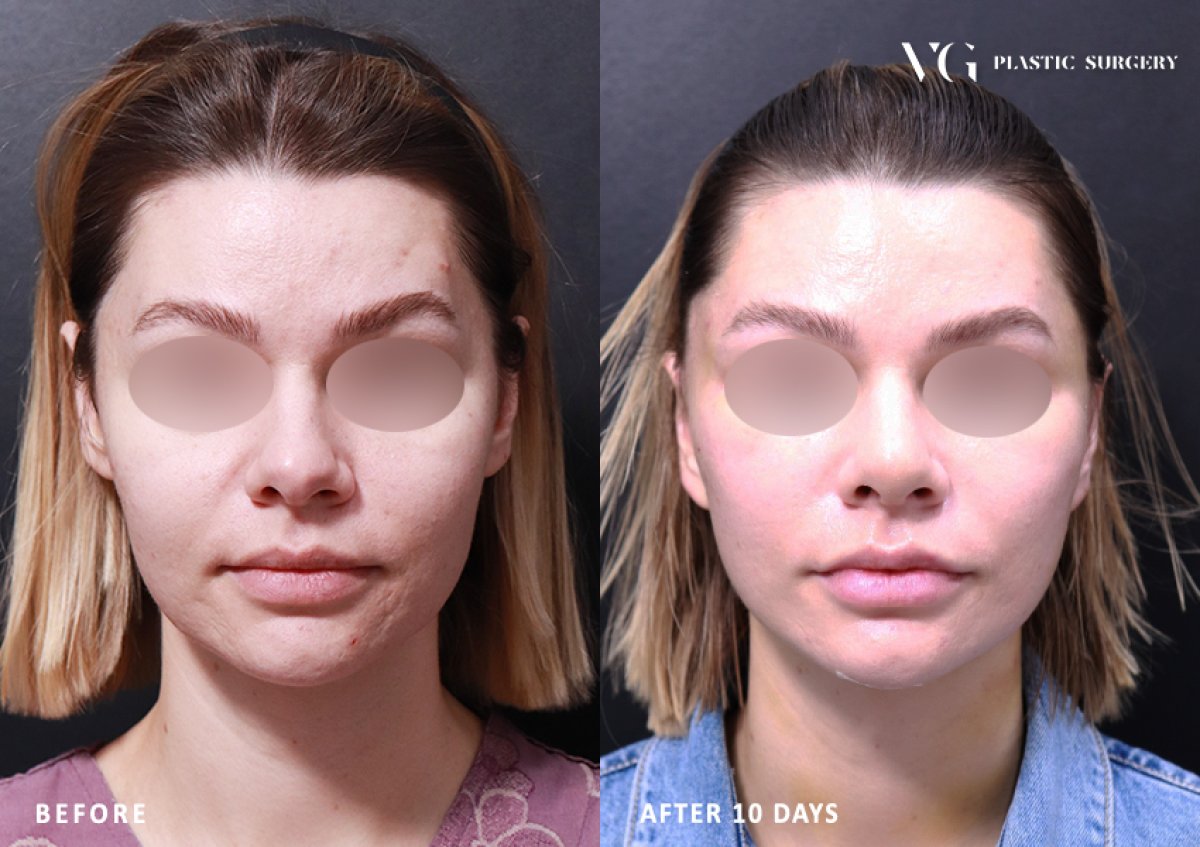 Resultados de minilifting facial en VG Plastic Surgery, rejuvenecimiento visible en 10 días