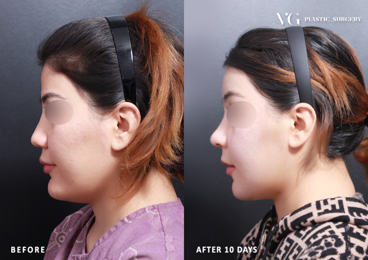 Результаты контурной пластики лица до и после в VG Plastic Surgery, улучшение линии челюсти