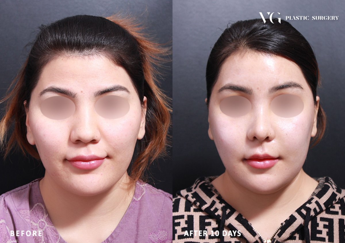 Before and after face contouring results at VG Plastic Surgery, visible facial shape improvement