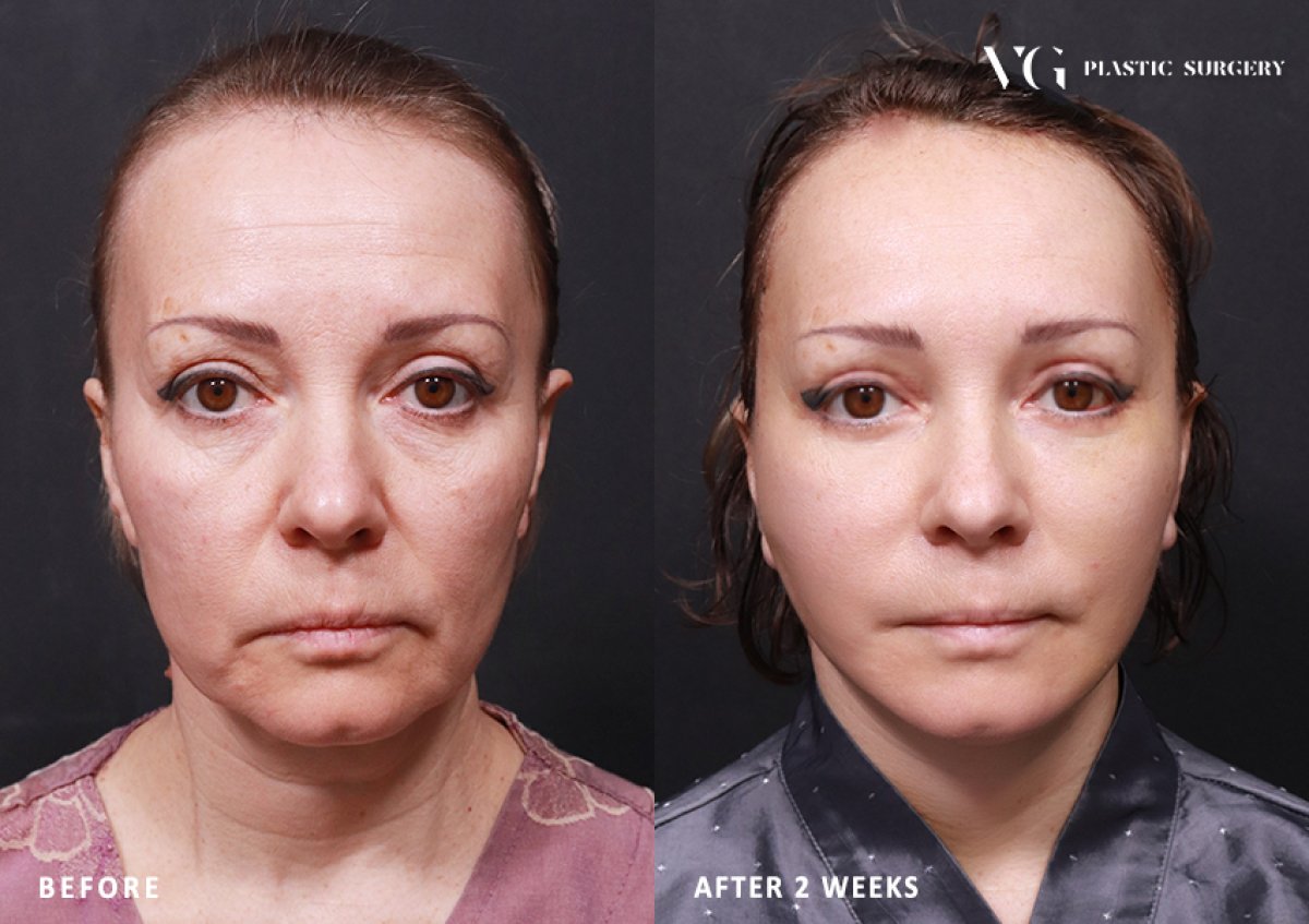 Resultados de lifting facial antes y después en VG Plastic Surgery – rejuvenecimiento en 2 semanas