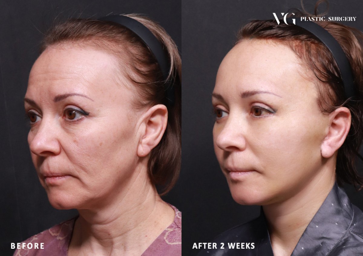 Resultados de lifting facial antes y después en VG Plastic Surgery – rejuvenecimiento en 2 semanas