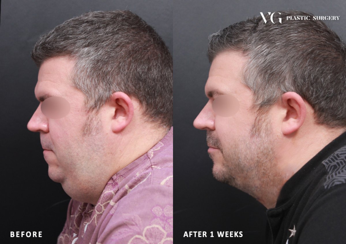 نتائج شفط الدهون قبل وبعد في VG Plastic Surgery، تحسين خط الفك والرقبة