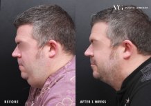 Fotos vor und nach Fettabsaugung durch Dr. 