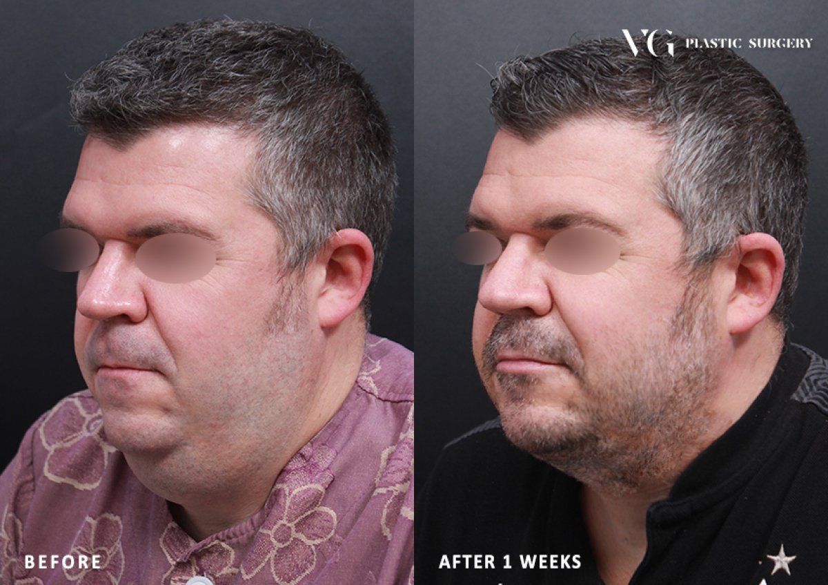 Before and after liposuction results at VG Plastic Surgery, visible chin and neck contouring