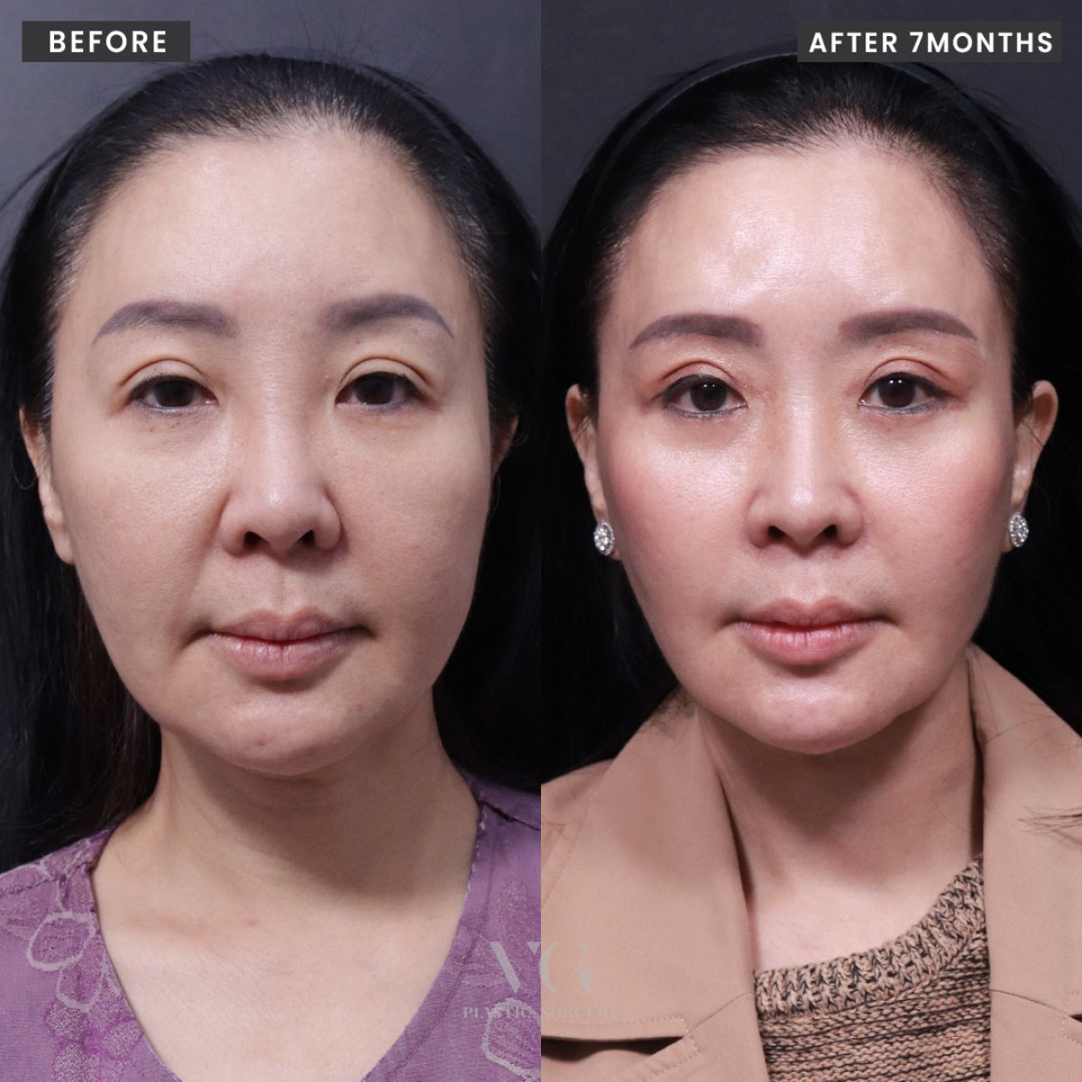 Resultados de lifting facial antes y después en VG Plastic Surgery, rejuvenecimiento a 7 meses