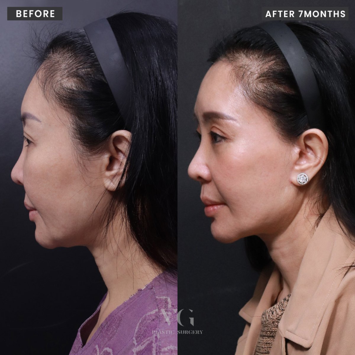 Resultados de lifting facial antes y después en VG Plastic Surgery, mejora del contorno facial