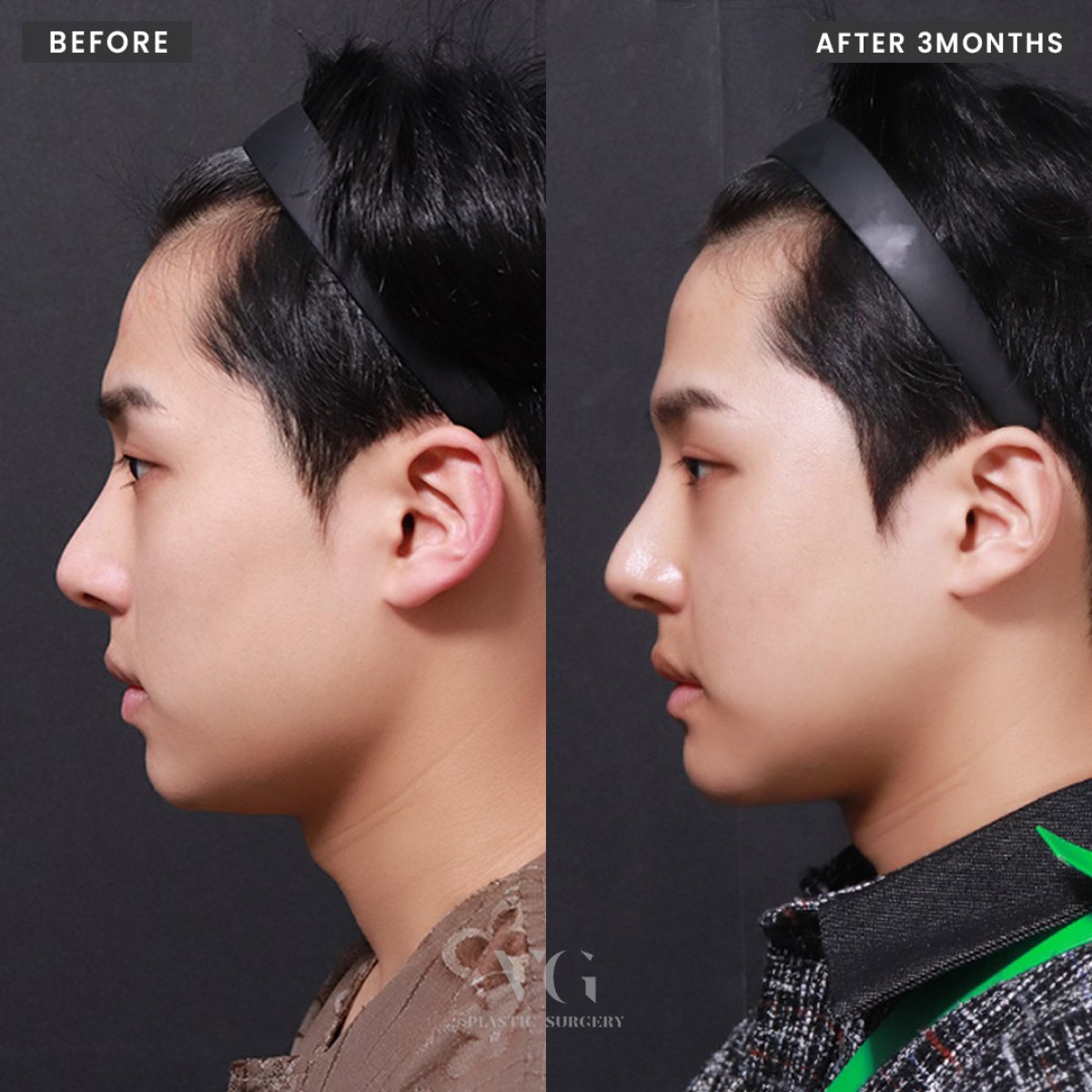 Before and after face contouring results at VG Plastic Surgery, improved jawline and profile