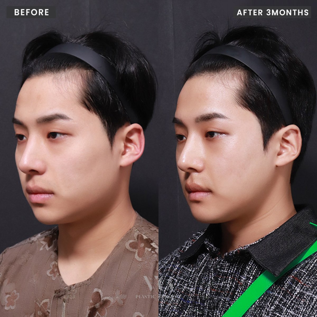 نتائج تحديد الوجه قبل وبعد في VG Plastic Surgery، تحسين واضح للفك