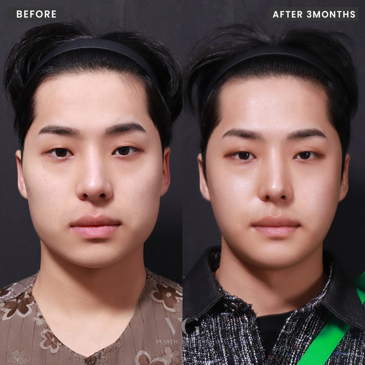Before and after face contouring results at VG Plastic Surgery, improved facial symmetry