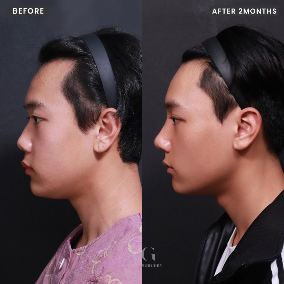 Resultado de rinoplastia antes y después en VG Plastic Surgery, perfil nasal mejorado tras 2 meses