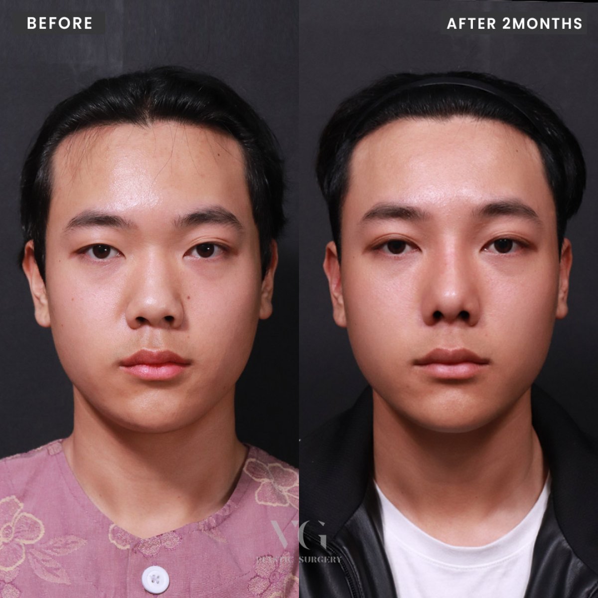 Before and after rhinoplasty results at VG Plastic Surgery, nose reshaping after 2 months