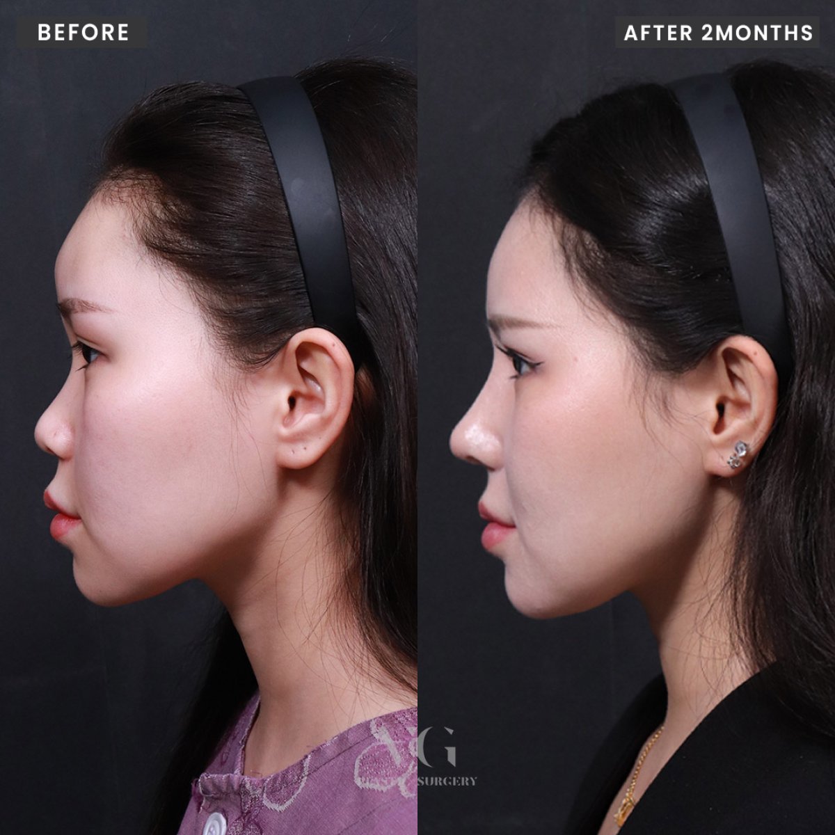نتائج عملية تجميل الأنف قبل وبعد في VG Plastic Surgery، تحسن شكل الأنف بعد شهرين