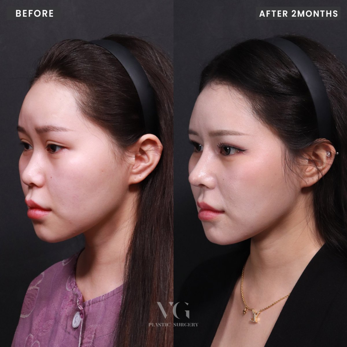 Efekty przed i po rhinoplastyce w VG Plastic Surgery, korekta nosa po 2 miesiącach