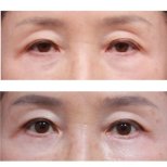 Fotos vor und nach Blepharoplastik (Augenlidkorrektur) durch Dr. Yong Woo Kim