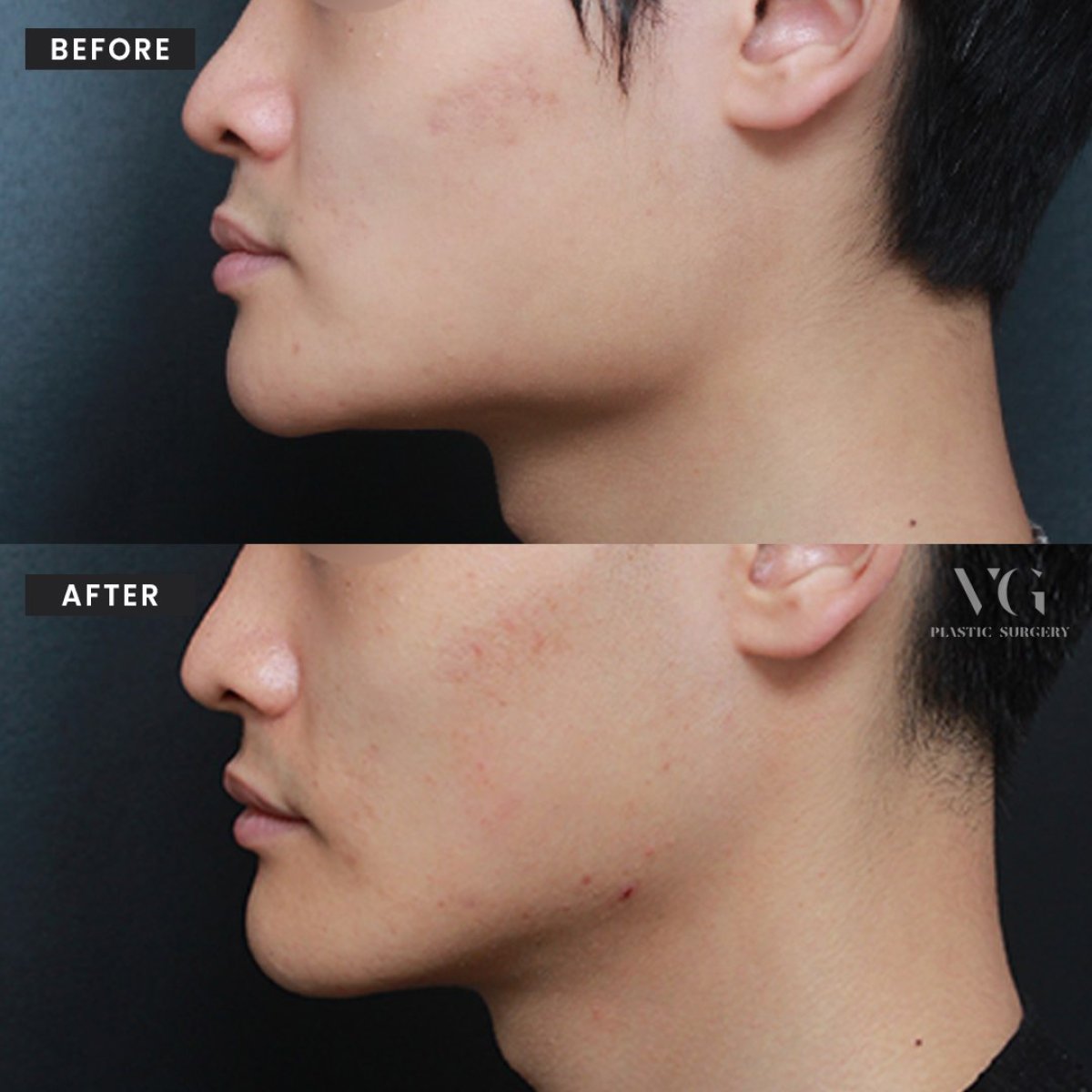 Before and after face contouring at VG Plastic Surgery, improved jawline and chin result