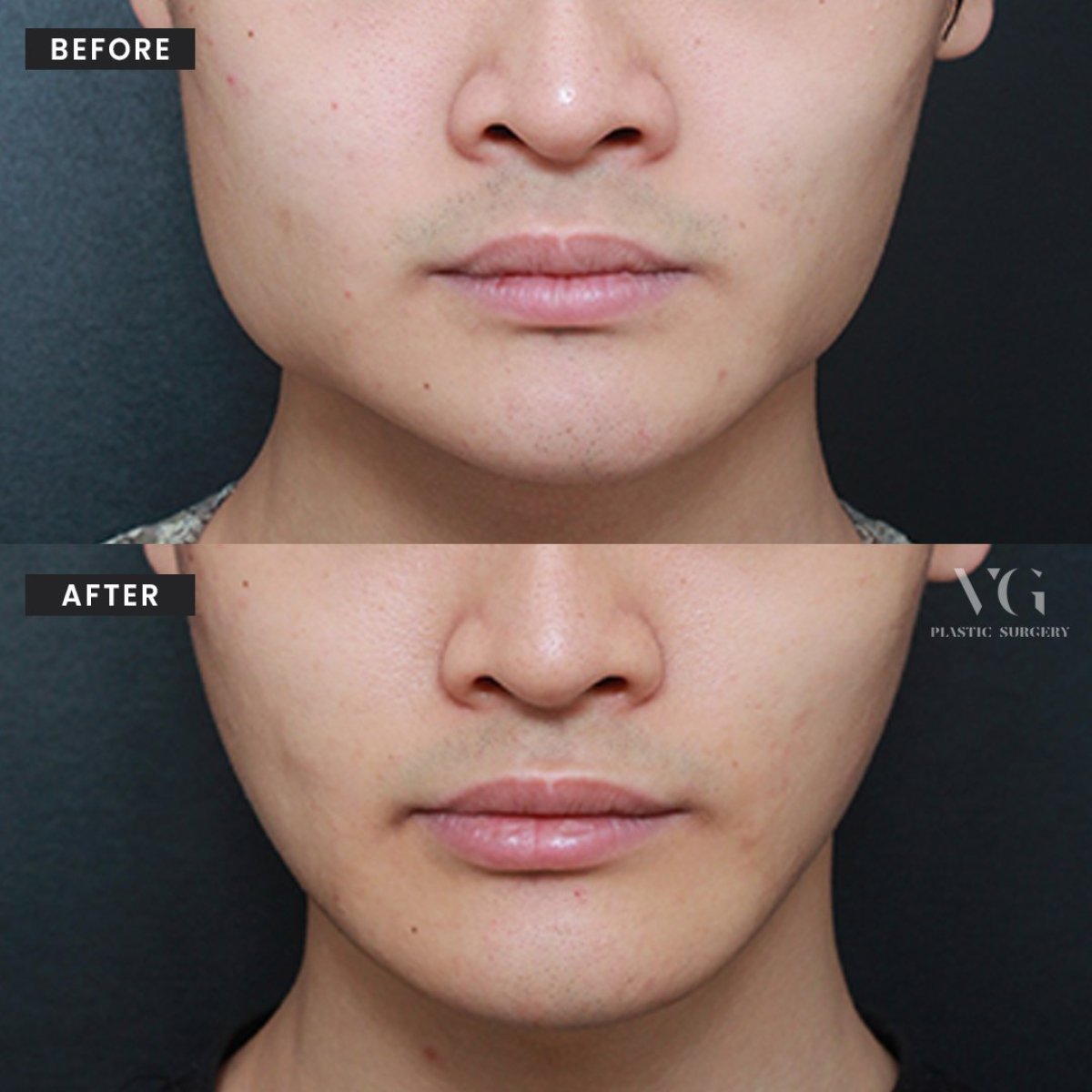 نتائج تحديد الوجه قبل وبعد في VG Plastic Surgery، تحسين خط الفك