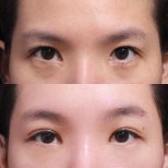 Fotos vor und nach Blepharoplastik (Augenlidkorrektur) durch Dr. Yong Woo Kim
