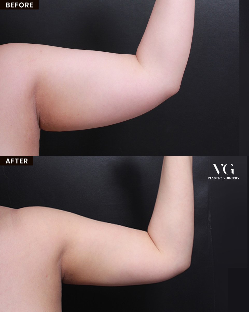 Vorher-nachher-Ergebnis der Armliposuktion bei VG Plastic Surgery, verbesserte Kontur