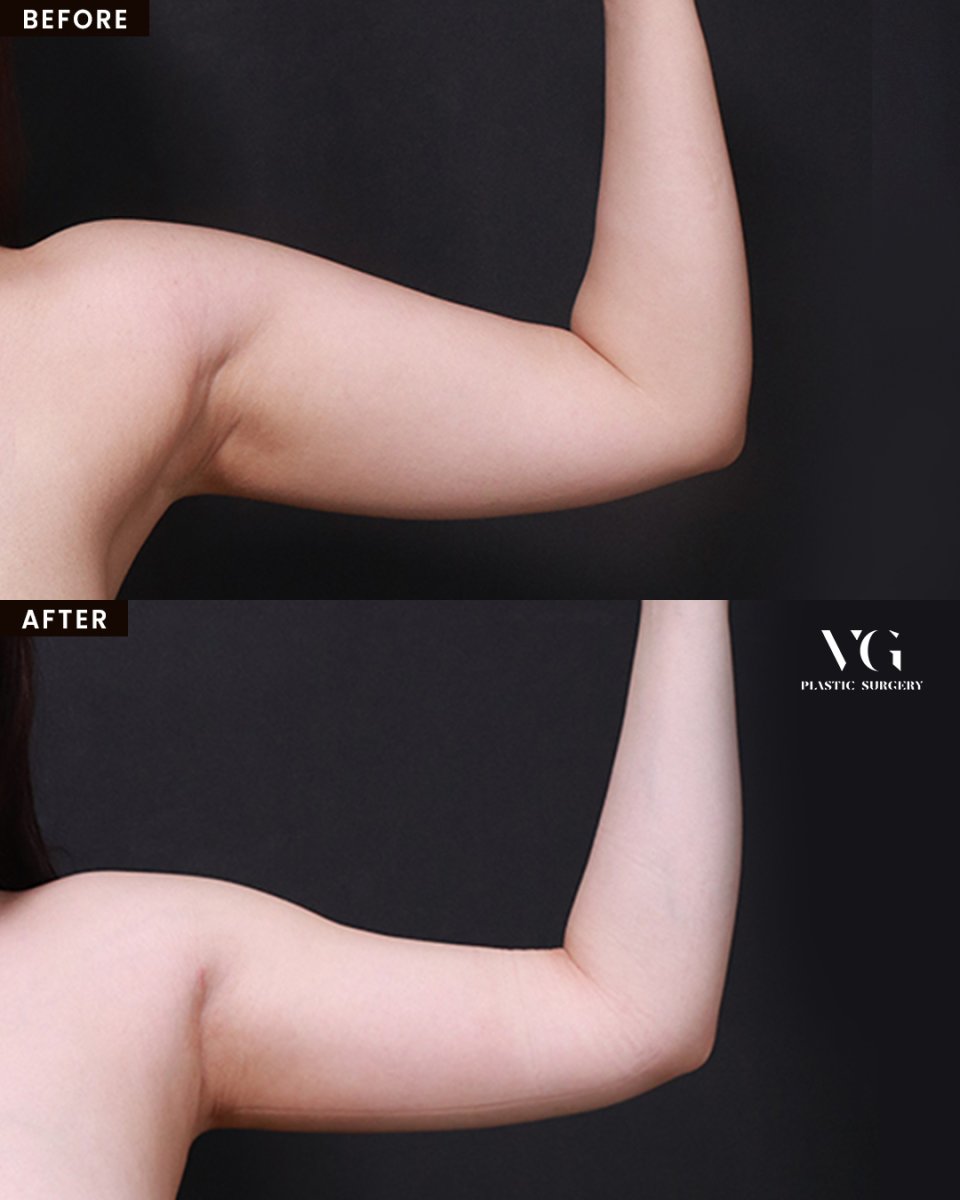 نتائج شفط دهون الذراع قبل وبعد في VG Plastic Surgery، تحسن واضح في شكل الذراع