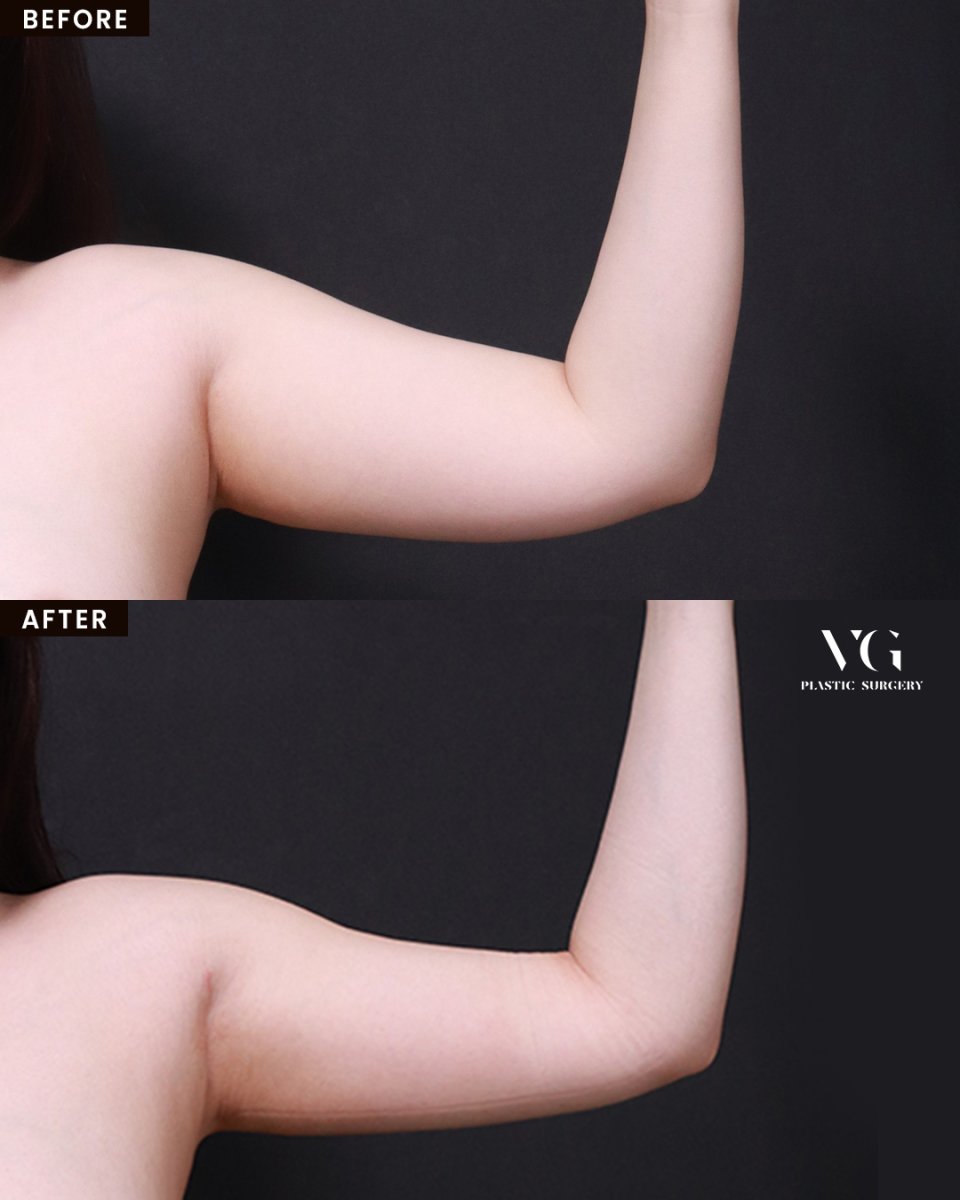 نتائج شفط دهون الذراع قبل وبعد في VG Plastic Surgery مع تحسين واضح لشكل الذراع