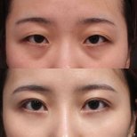 Fotos vor und nach Blepharoplastik (Augenlidkorrektur) durch Dr. Yong Woo Kim