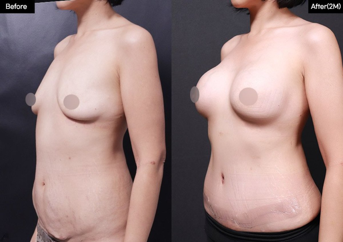Résultats avant et après abdominoplastie chez VG Plastic Surgery, amélioration du contour abdominal