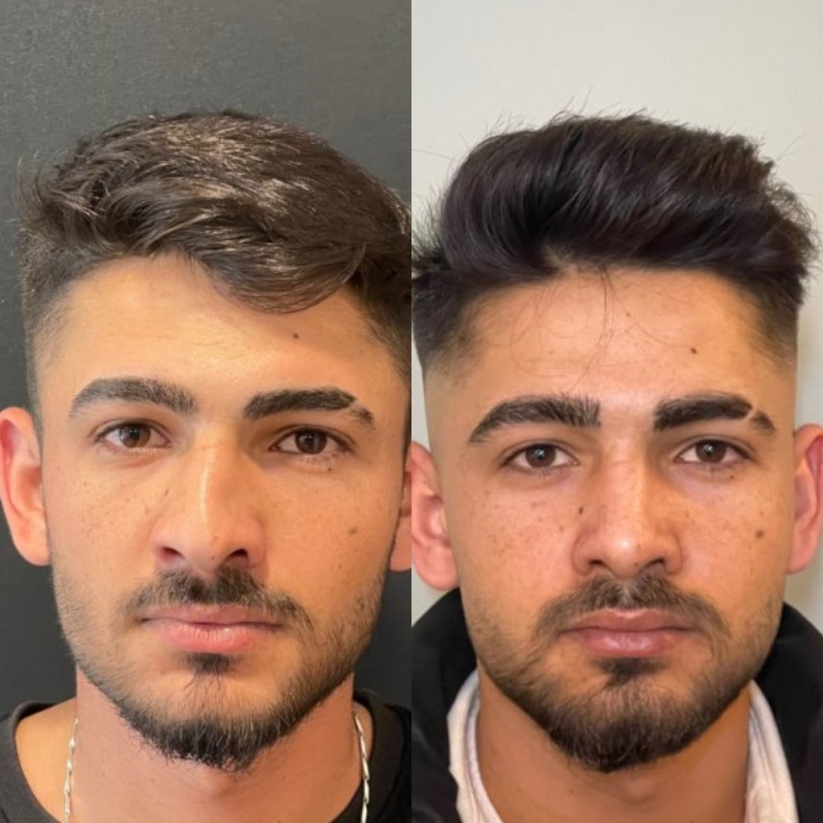 نتائج تجميل الأنف قبل وبعد في عيادة Op. Dr. Sinan Eroglu، تحسين شكل الأنف