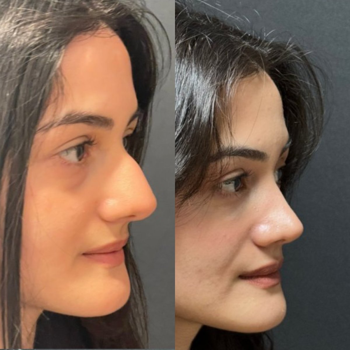 Résultats avant/après rhinoplastie à la clinique Op. Dr. Sinan Eroglu, remodelage du nez