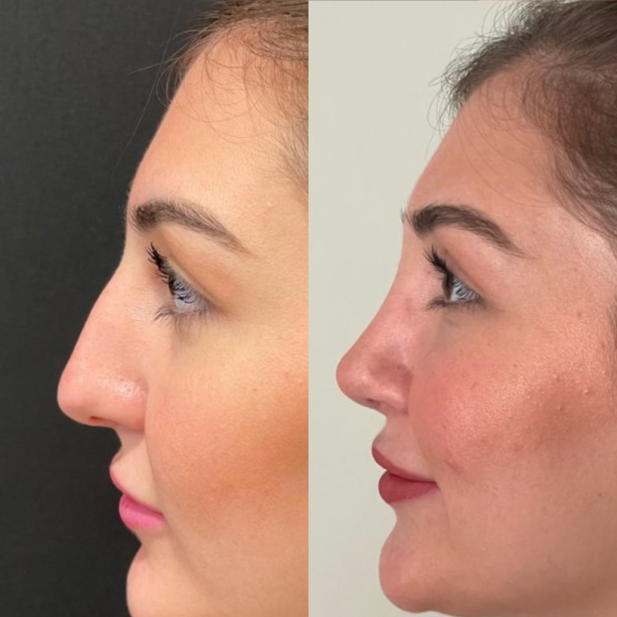 Résultats avant et après rhinoplastie à la clinique Op. Dr. Sinan Eroglu, remodelage du nez