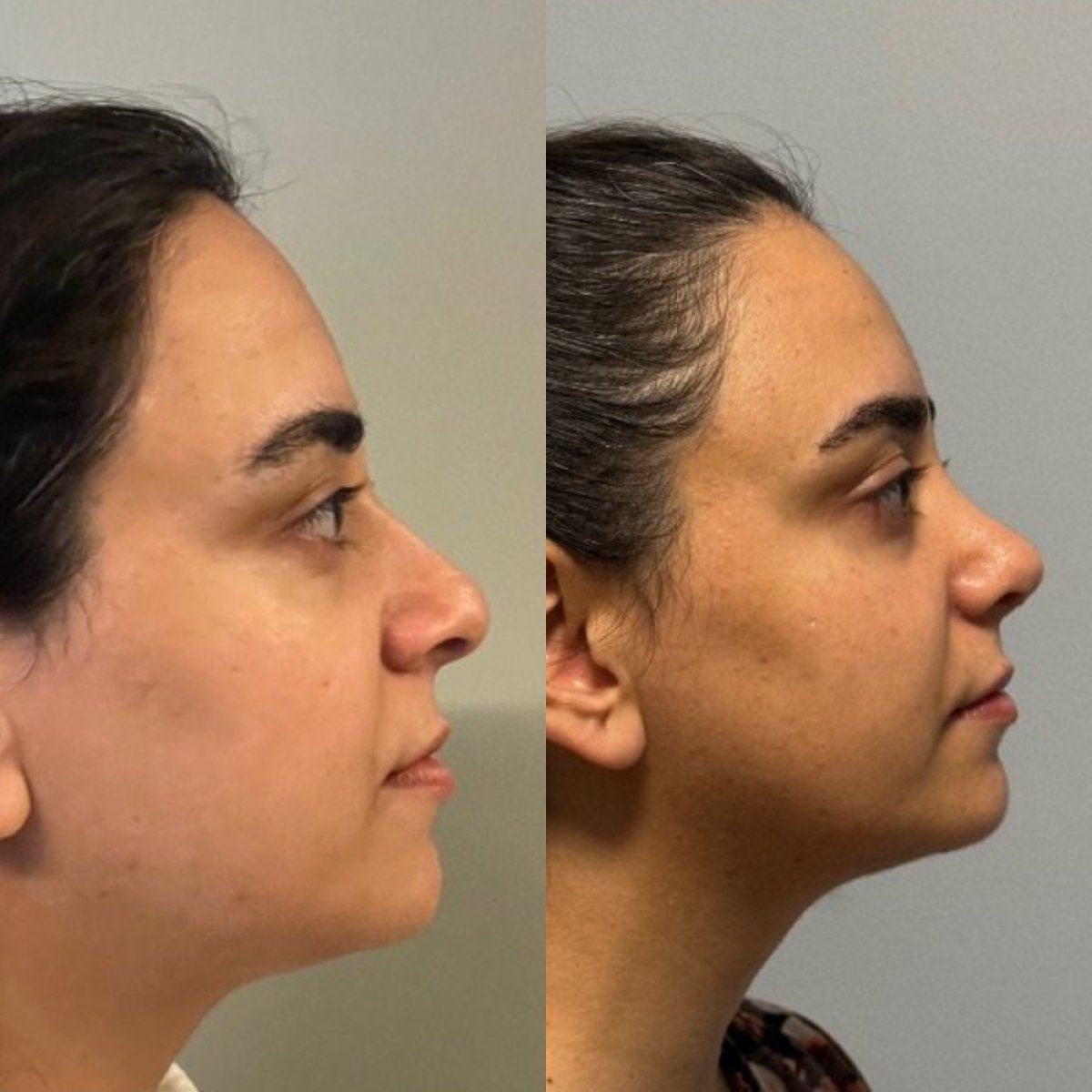 Before and after revision rhinoplasty results at Op. Dr. Sinan Eroglu Clinic, nose reshaping