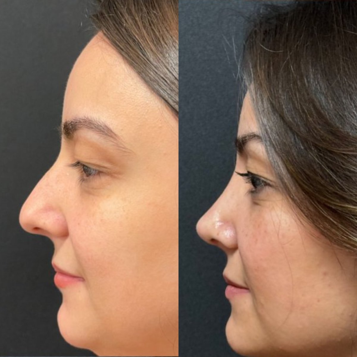 Résultats avant et après rhinoplastie à la clinique Op. Dr. Sinan Eroglu, profil du nez amélioré