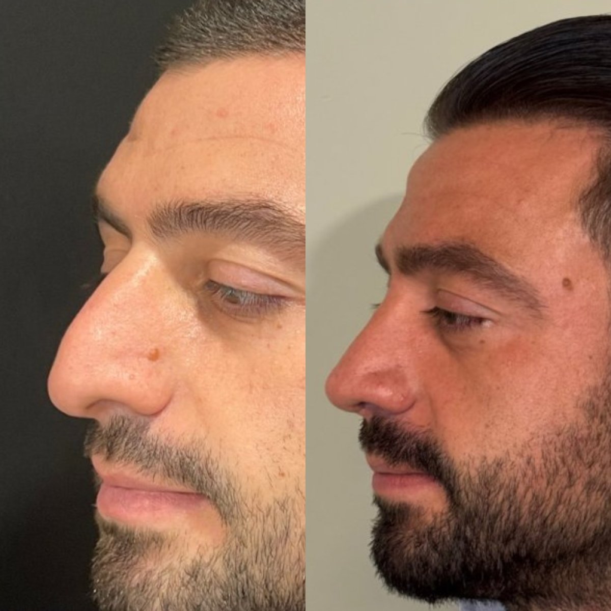 Результат до та після ревізійної ринопластики в Op. Dr. Sinan Eroglu Clinic, покращена форма носа