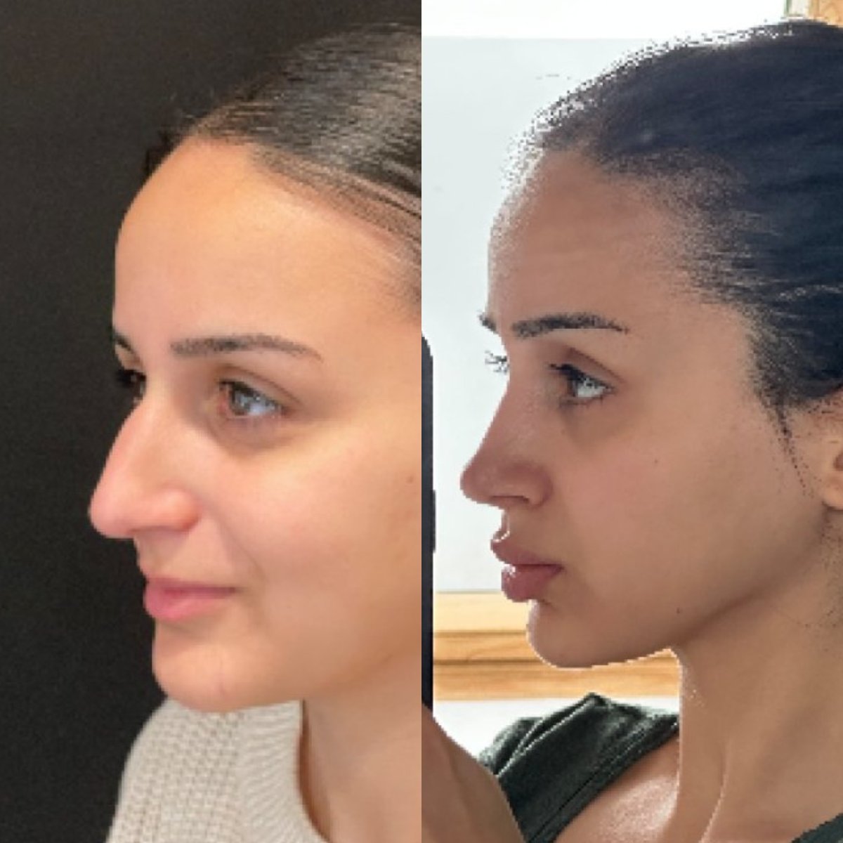 نتائج تجميل الأنف قبل وبعد في عيادة Op. Dr. Sinan Eroglu، إعادة تشكيل الأنف