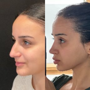 Rhinoplasty + Brow Lift Package All Included - photo 4