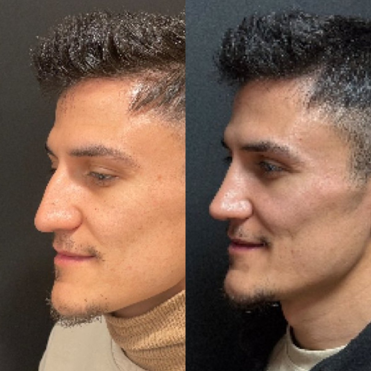 نتائج تجميل الأنف قبل وبعد في عيادة Op. Dr. Sinan Eroglu، تحسين شكل الأنف