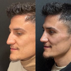 Rhinoplasty + Brow Lift Package All Included - photo 5