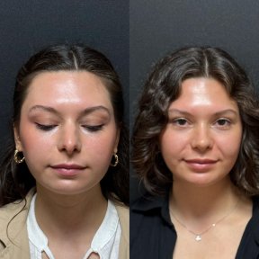 Revision Rhinoplasty — 6 Nights at 4★ Hotel & VIP Transfer Included - photo 4
