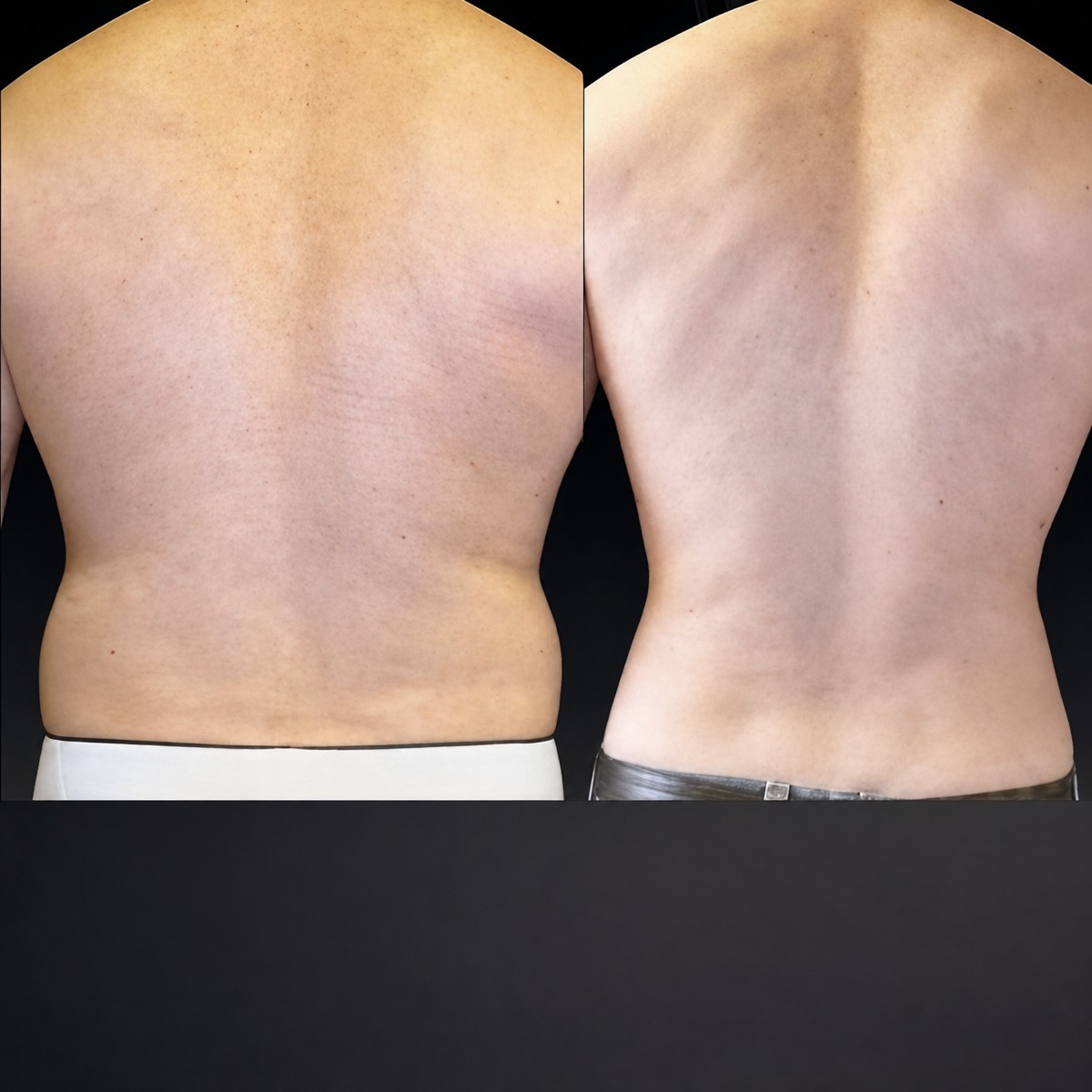 Resultados de lipoescultura 360 antes y después en Memorial Bahçelievler Hospital, espalda más delgada