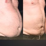 Before and after Liposuction photos by Dr. 