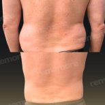 Before and after Liposuction photos by Dr. 