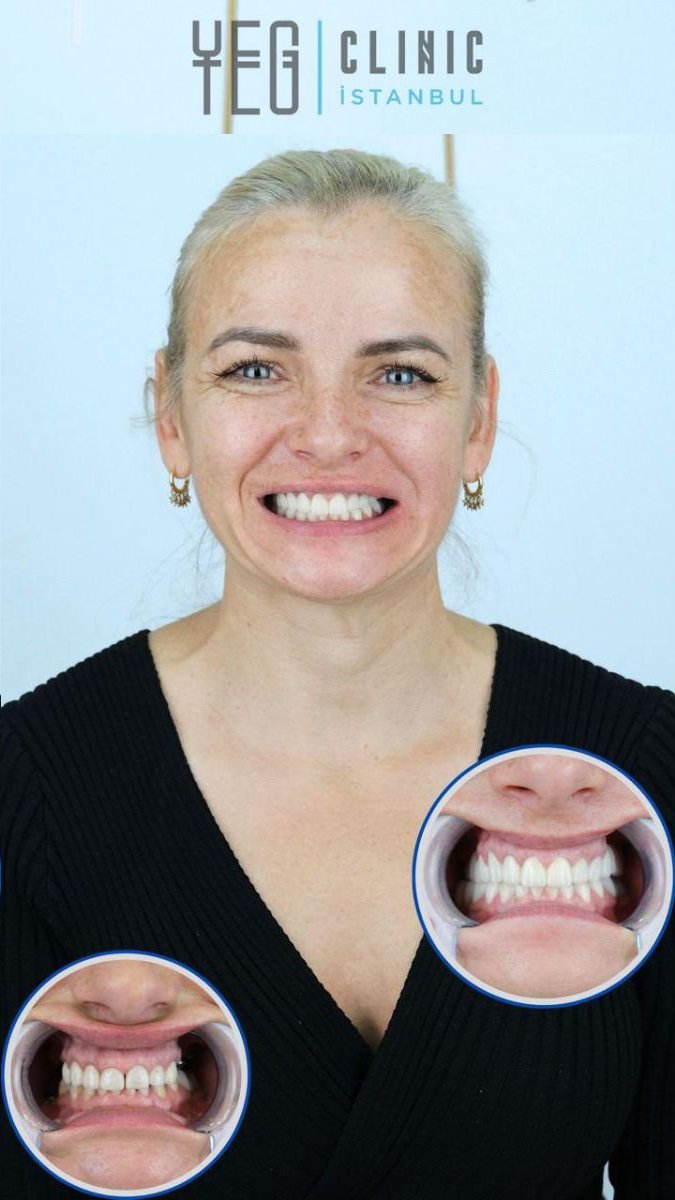 Resultado antes y después de implantes dentales Straumann en YEG Clinic, sonrisa mejorada