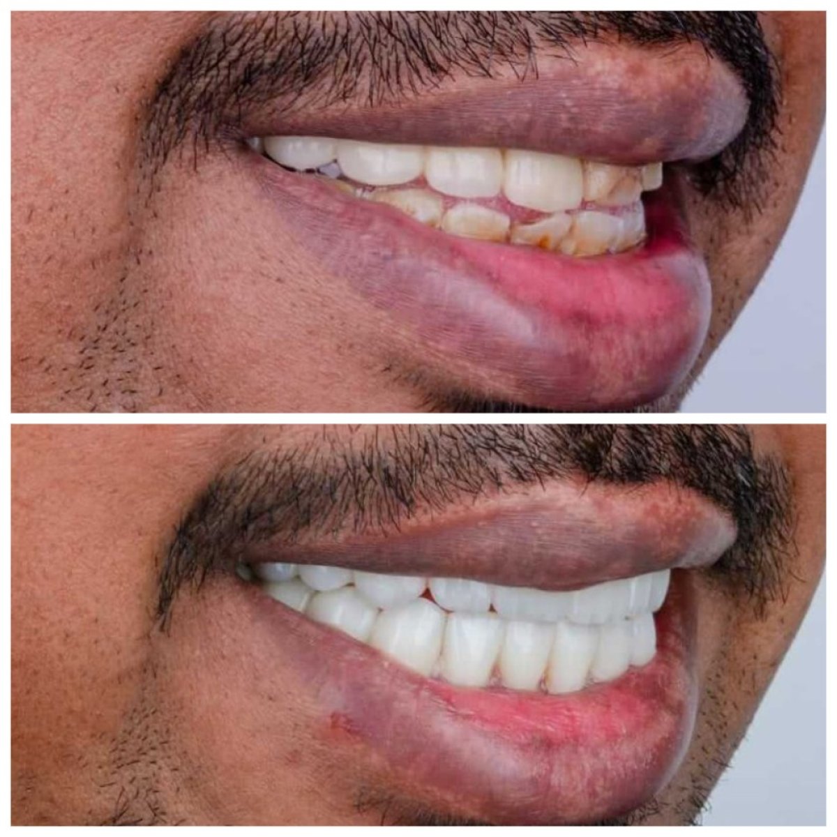 Результаты до и после установки циркониевых коронок в Omara Dental Centers, улучшение улыбки